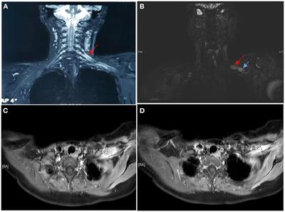 Case report: Brachial plexopathy caused by malignant peripheral nerve sheath tumor and review of the literature